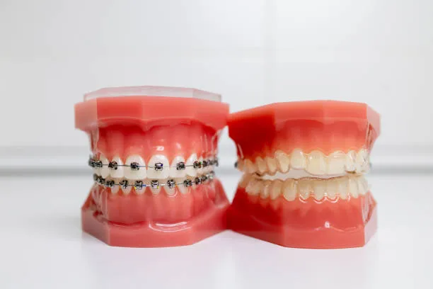 Comparison between Invisalign and traditional braces
